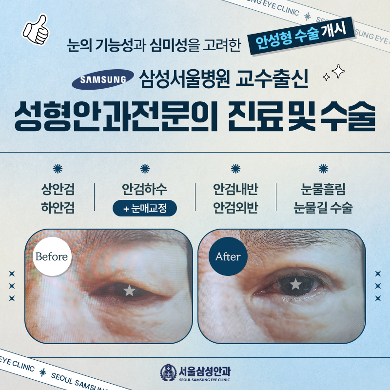 안성형 수술