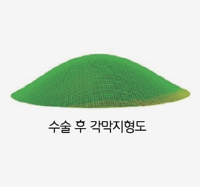 규칙적인 형태의 각막