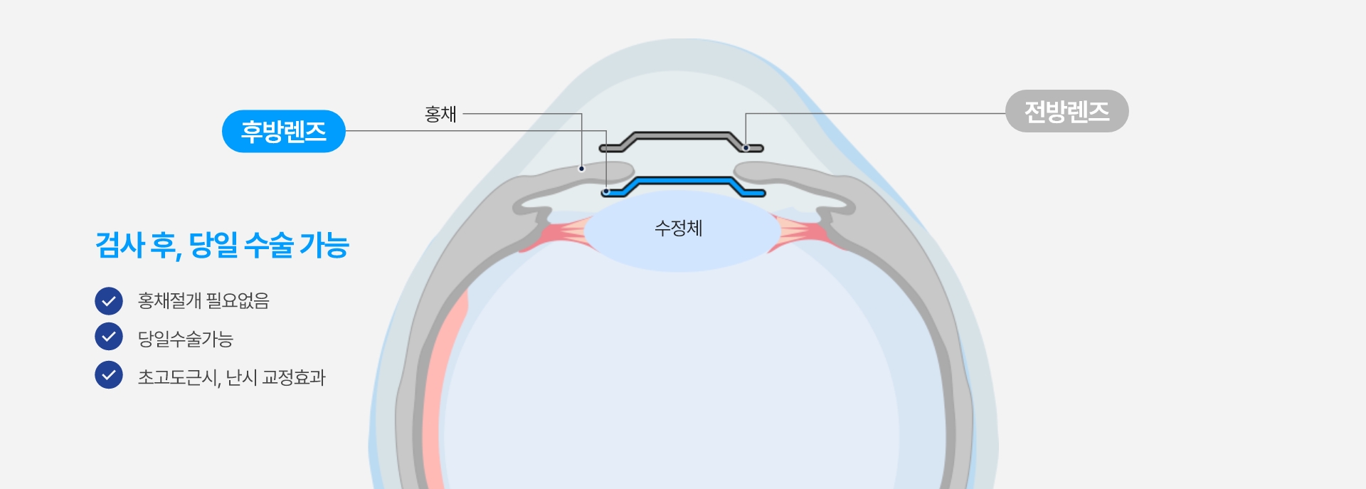 안내렌즈 삽입술 내용