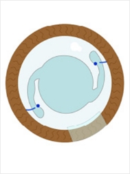 인공수정체 공막고정술