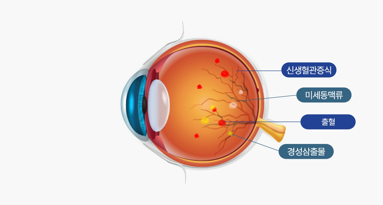 당뇨망막병증 이미지