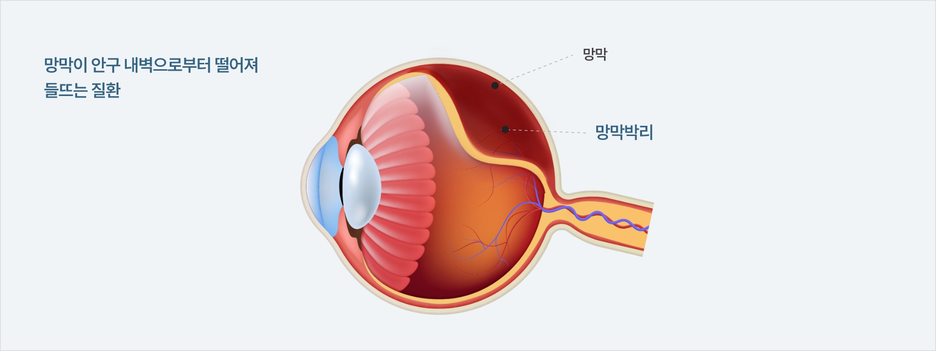 망막이 안구 내벽으로부터 떨어져
들뜨는 질환