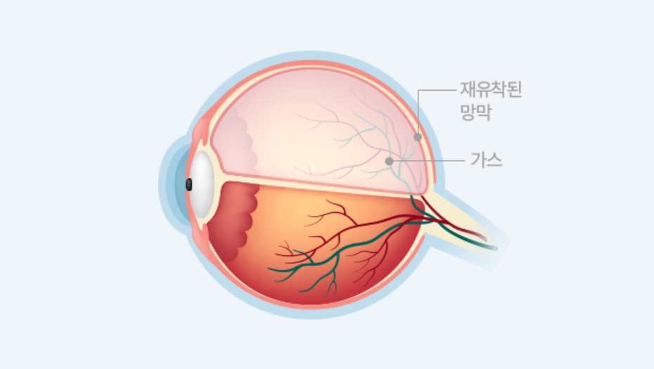 기체망막유착술