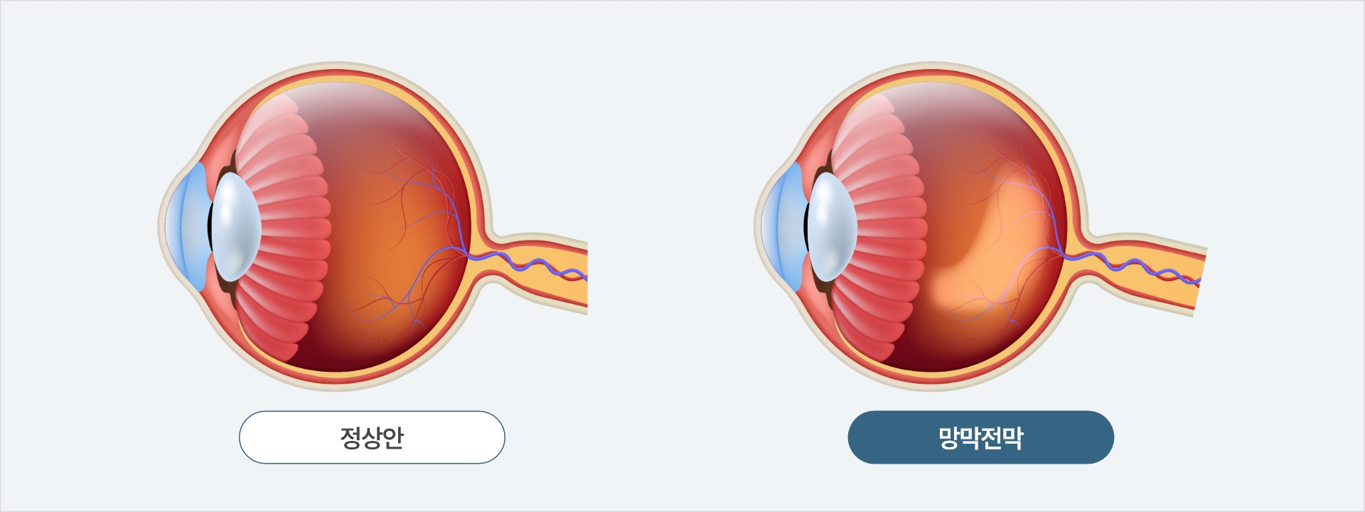 정상 안구와 망막전막의 비교