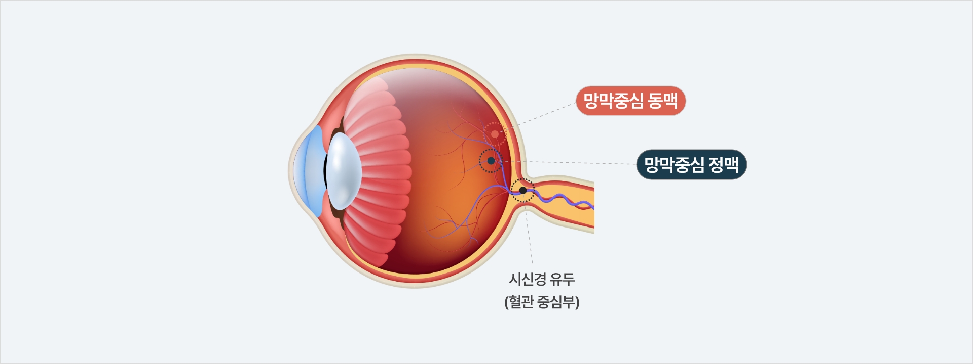 망막중심 혈관이 막힌 일러스트