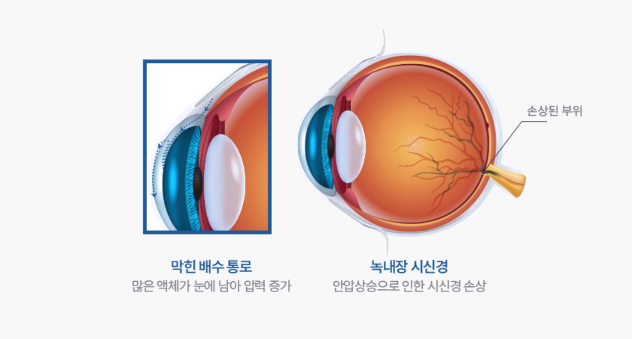 막힌 배수 통로 : 많은 액체가 눈에 남아 압력 증가/ 녹내장 시신경 : 안압상승으로 인한 시신경 손상