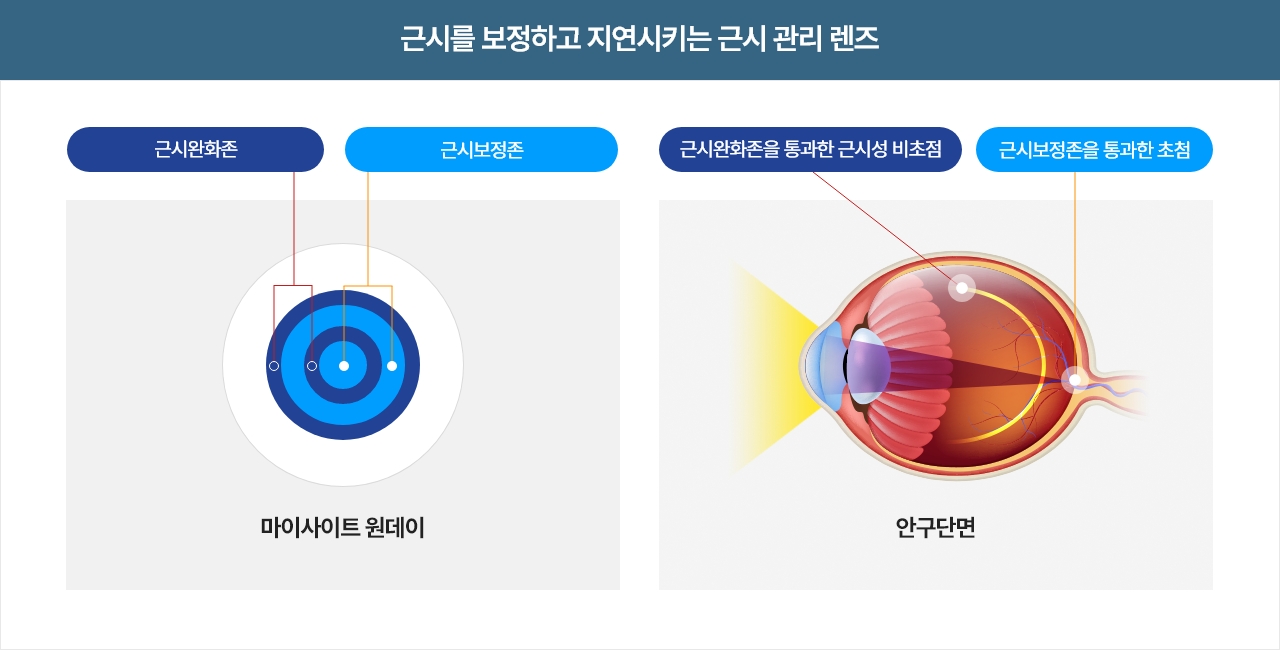 근시를 보정하고 지시키는 근시 관리 렌즈