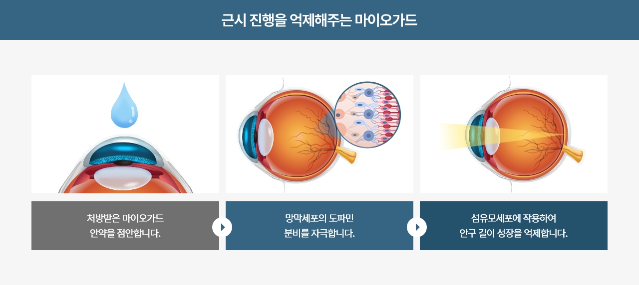 근시 진행을 억제해주는 마이오가드